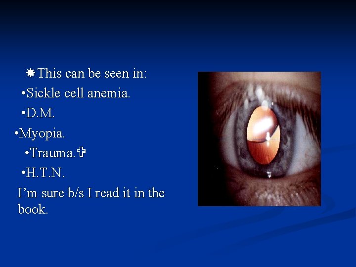  This can be seen in: • Sickle cell anemia. • D. M. •