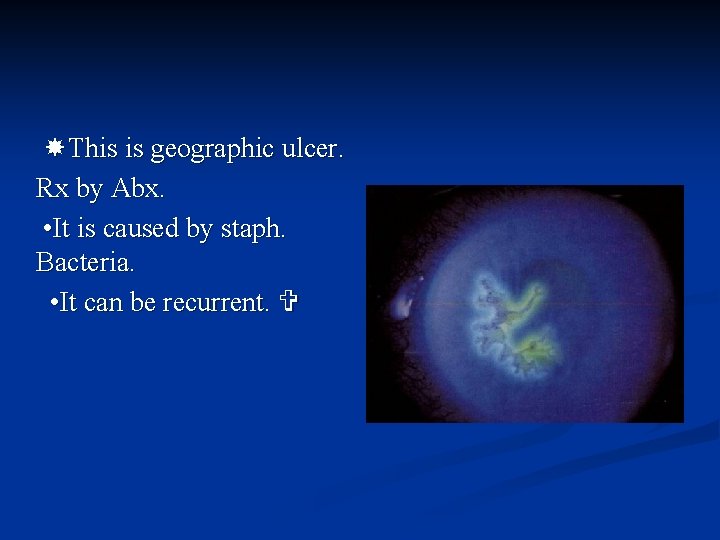  This is geographic ulcer. Rx by Abx. • It is caused by staph.