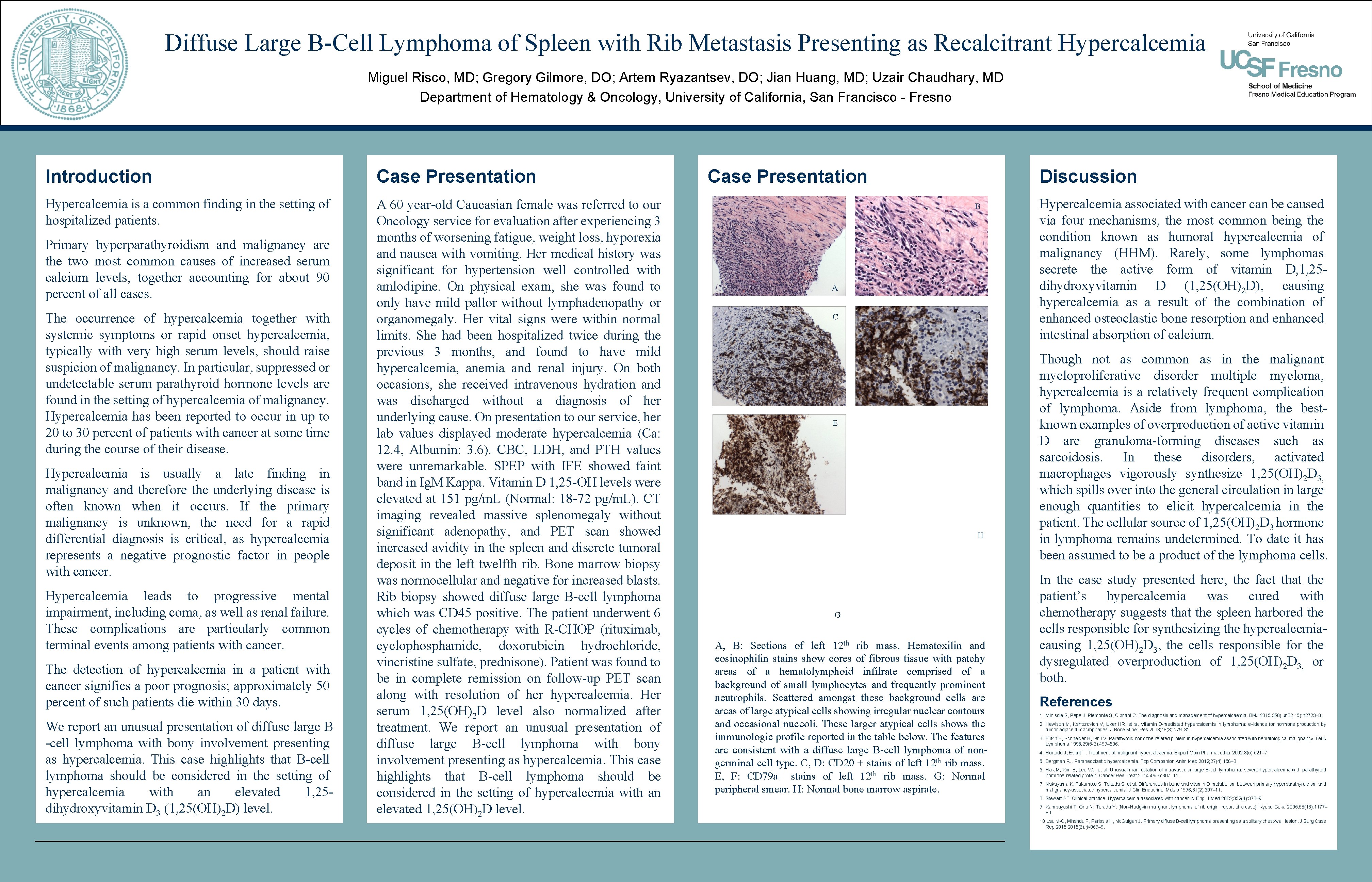 Diffuse Large B-Cell Lymphoma of Spleen with Rib Metastasis Presenting as Recalcitrant Hypercalcemia Miguel