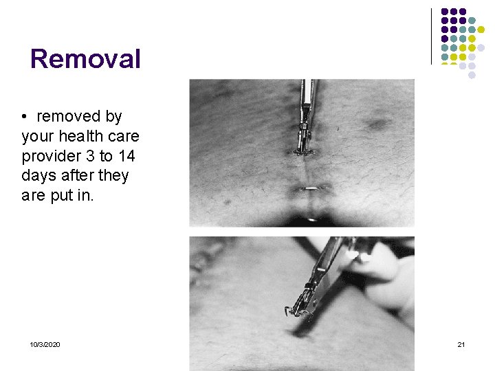 Removal • removed by your health care provider 3 to 14 days after they Removal • removed by your health care provider 3 to 14 days after they