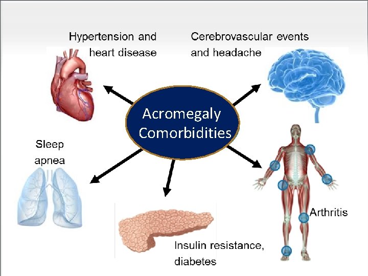Acromegaly Comorbidities 