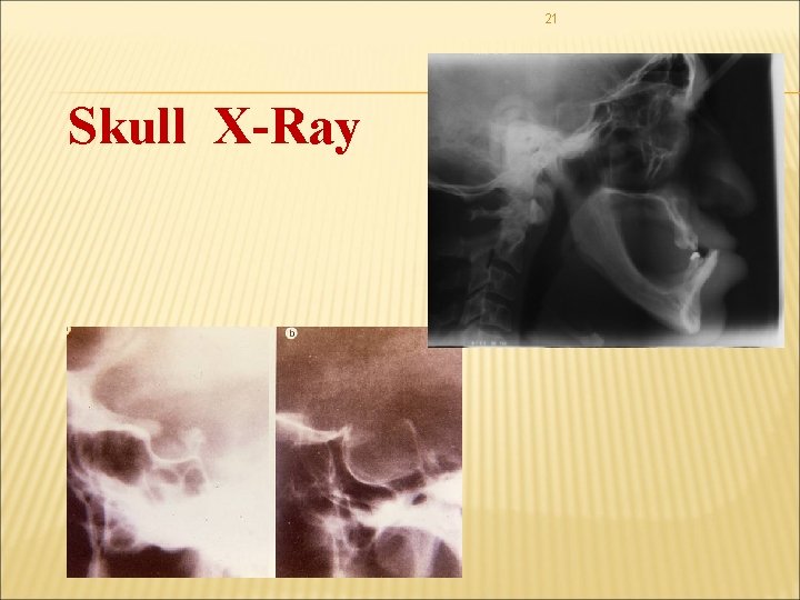 21 Skull X-Ray 