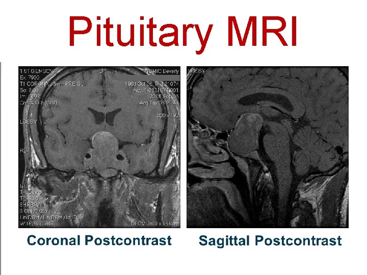 Pituitary MRI 