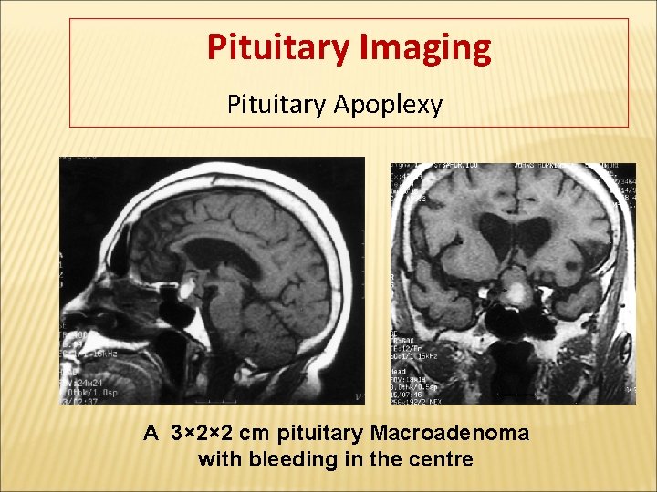 Pituitary Imaging Pituitary Apoplexy A 3× 2× 2 cm pituitary Macroadenoma with bleeding in