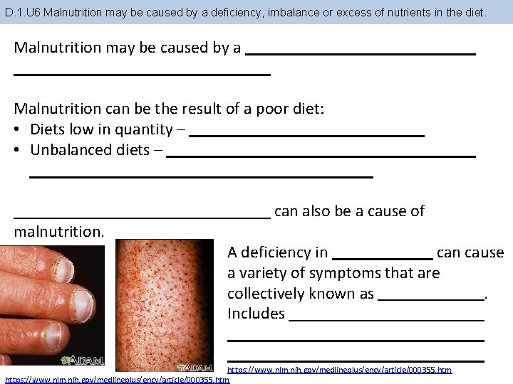 D. 1. U 6 Malnutrition may be caused by a deficiency, imbalance or excess