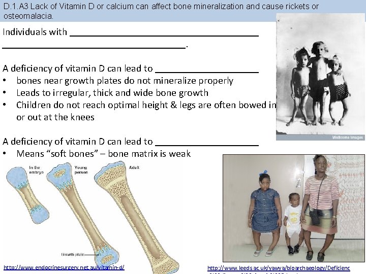 D. 1. A 3 Lack of Vitamin D or calcium can affect bone mineralization