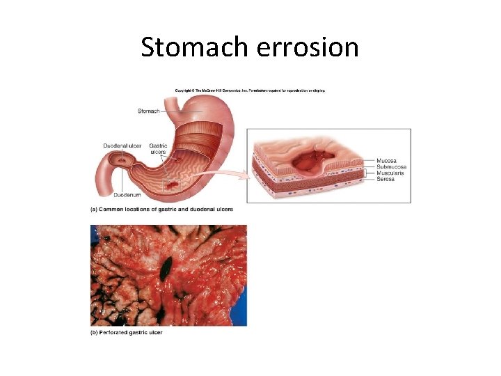 Stomach errosion 