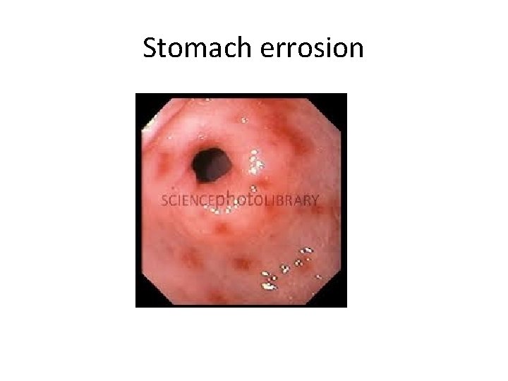 Stomach errosion 
