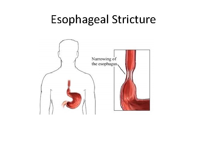 Esophageal Stricture 
