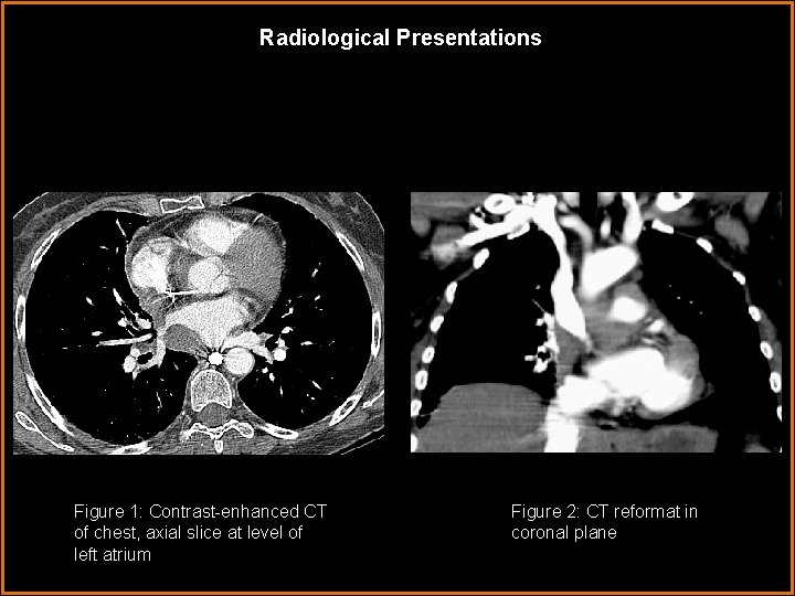 Radiological Presentations Figure 1: Contrast-enhanced CT of chest, axial slice at level of left