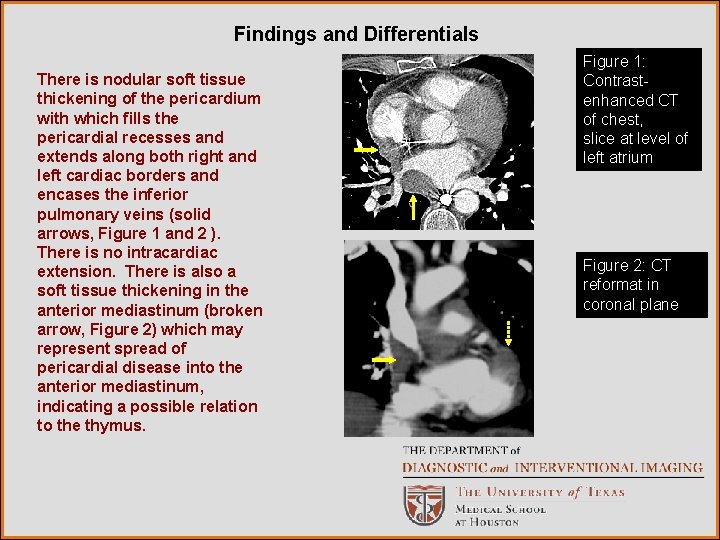 Findings and Differentials There is nodular soft tissue thickening of the pericardium with which