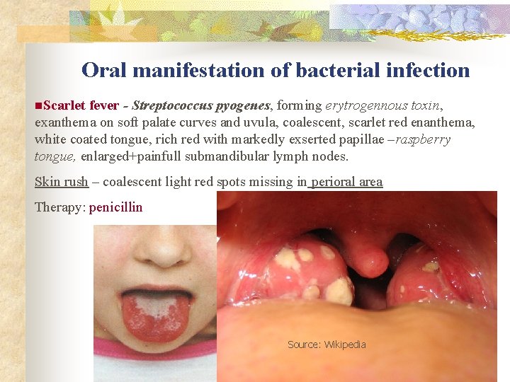 Oral manifestation of bacterial infection n. Scarlet fever - Streptococcus pyogenes, forming erytrogennous toxin,