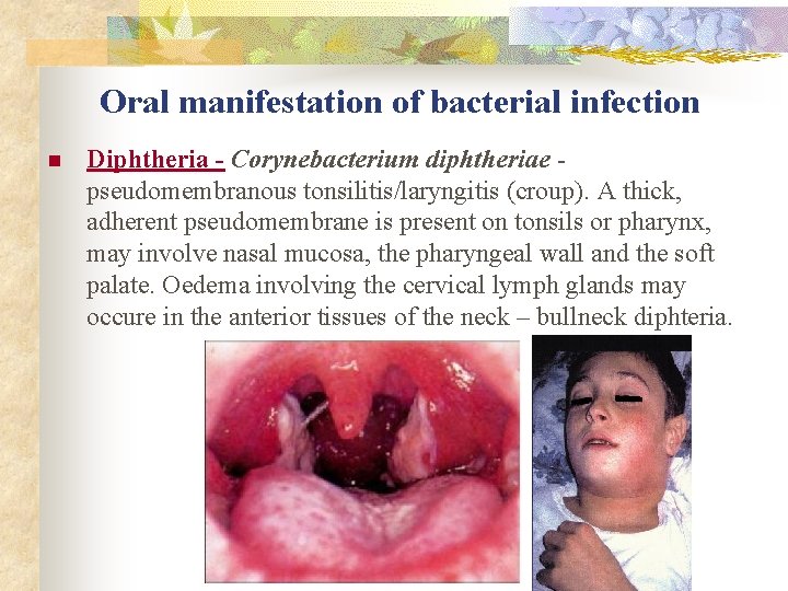 Oral manifestation of bacterial infection n Diphtheria - Corynebacterium diphtheriae pseudomembranous tonsilitis/laryngitis (croup). A