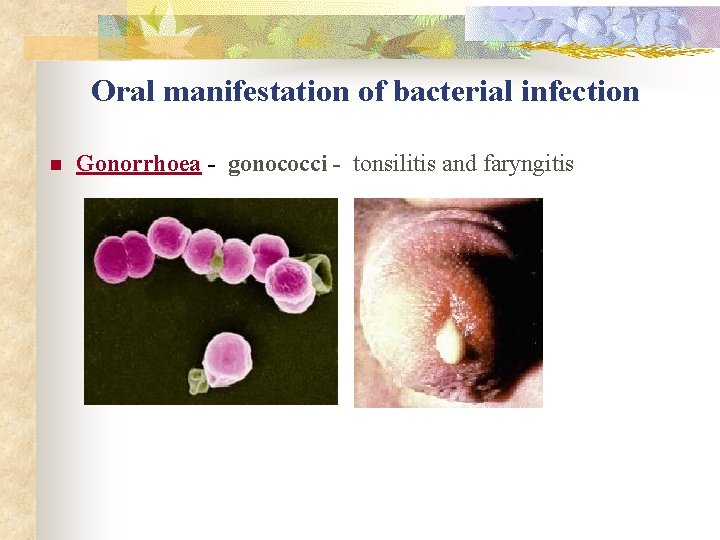 Oral manifestation of bacterial infection n Gonorrhoea - gonococci - tonsilitis and faryngitis 