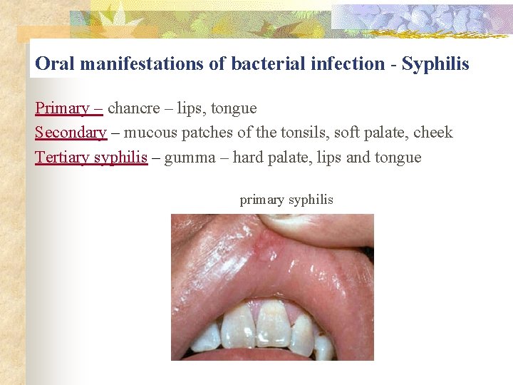 Oral manifestations of bacterial infection - Syphilis Primary – chancre – lips, tongue Secondary