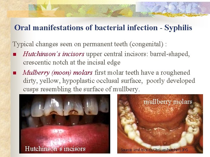 Oral manifestations of bacterial infection - Syphilis Typical changes seen on permanent teeth (congenital)