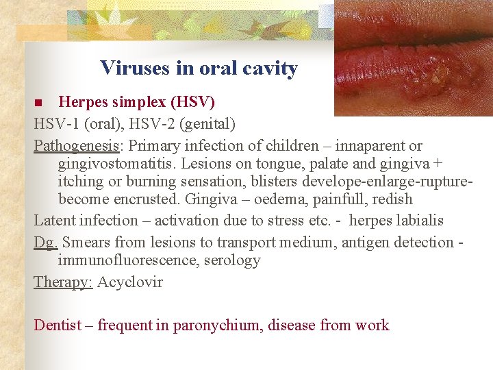 Viruses in oral cavity Herpes simplex (HSV) HSV-1 (oral), HSV-2 (genital) Pathogenesis: Primary infection
