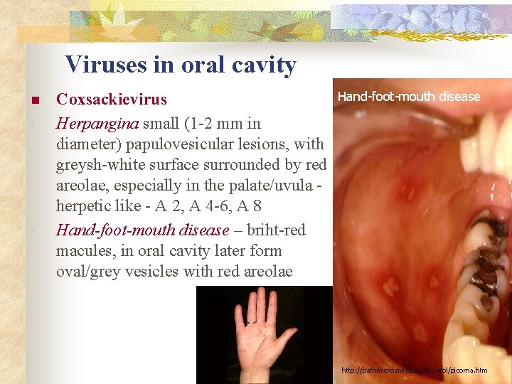 Viruses in oral cavity n • • Coxsackievirus Herpangina small (1 -2 mm in