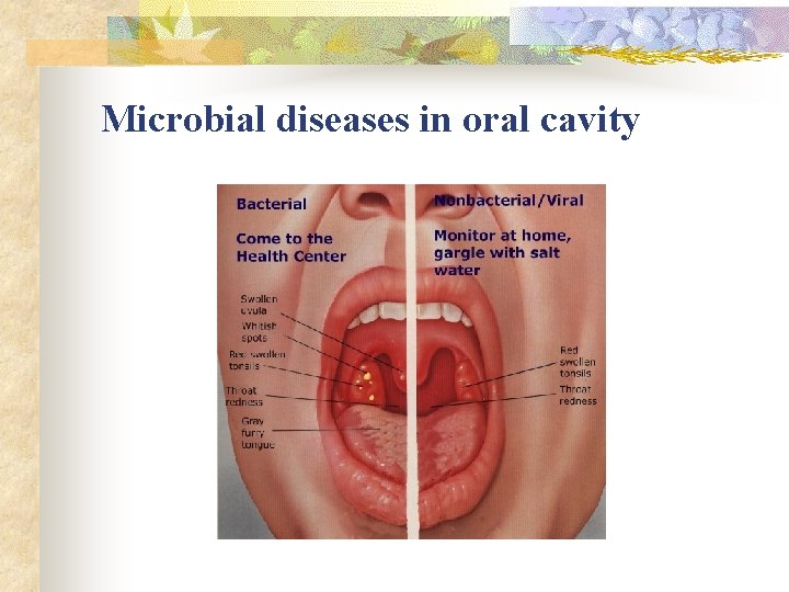 Microbial diseases in oral cavity 