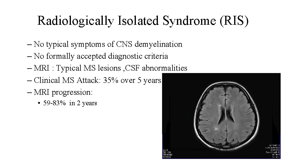Radiologically Isolated Syndrome (RIS) – No typical symptoms of CNS demyelination – No formally