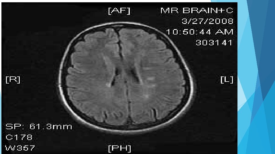 Case : MRI Brain 