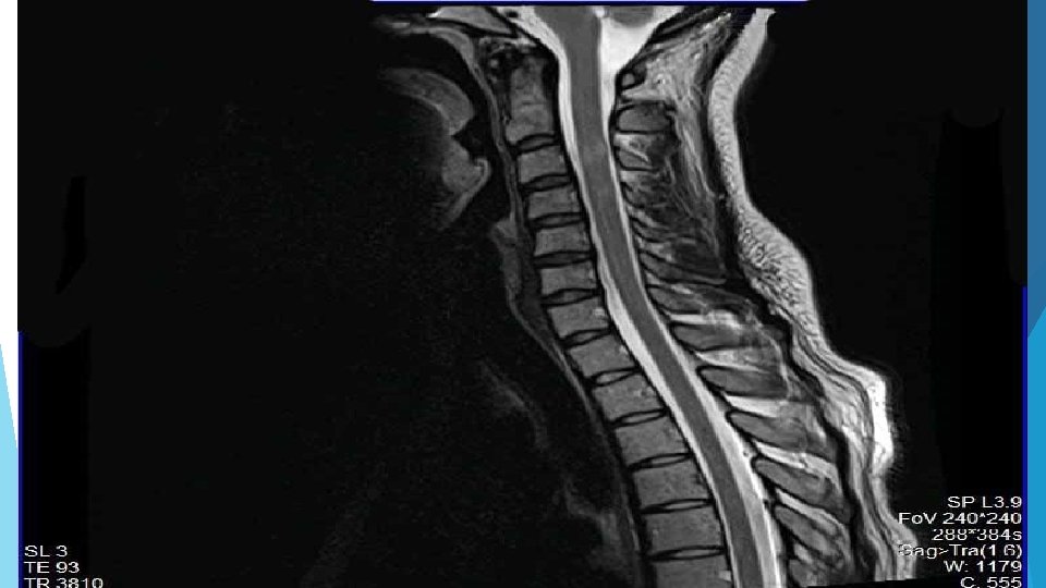 Case 2: MRI Spine 