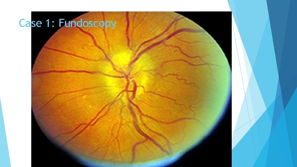 Case 1: Fundoscopy 