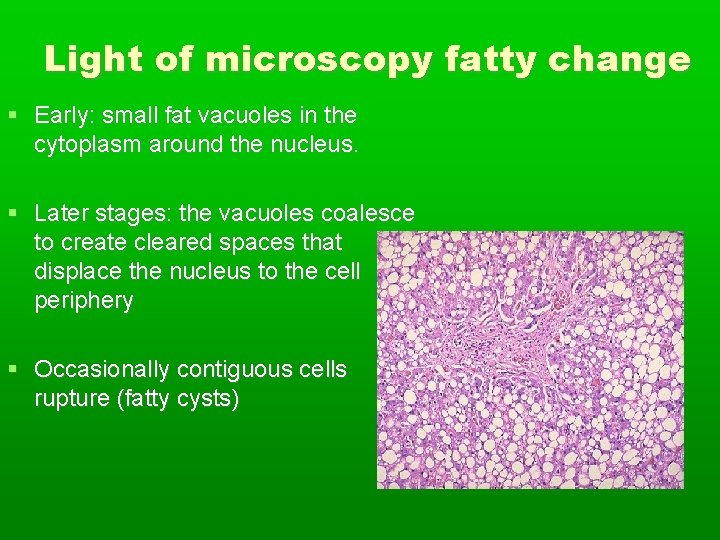 Light of microscopy fatty change Early: small fat vacuoles in the cytoplasm around the