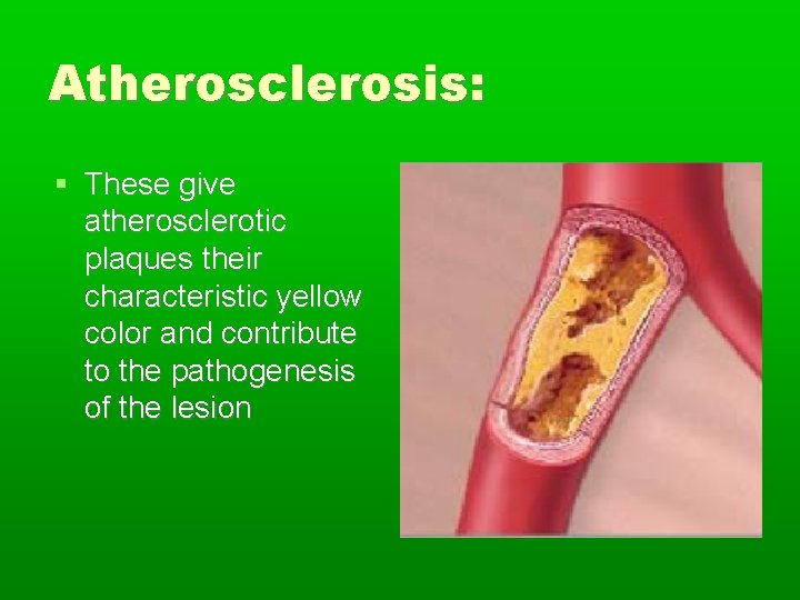 Atherosclerosis: These give atherosclerotic plaques their characteristic yellow color and contribute to the pathogenesis