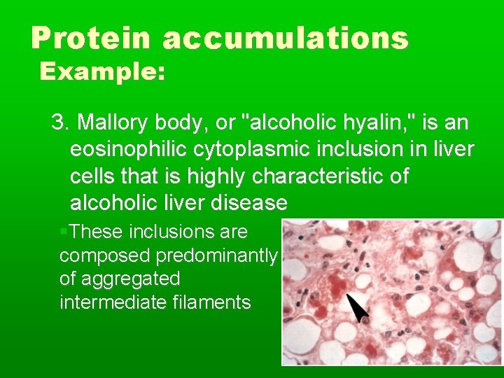 Protein accumulations Example: 3. Mallory body, or "alcoholic hyalin, " is an eosinophilic cytoplasmic