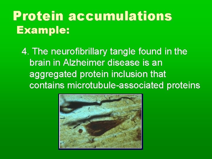 Protein accumulations Example: 4. The neurofibrillary tangle found in the brain in Alzheimer disease