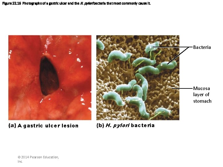 Figure 22. 16 Photographs of a gastric ulcer and the H. pylori bacteria that