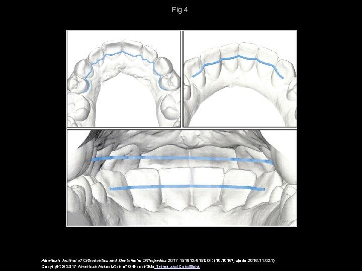 Fig 4 American Journal of Orthodontics and Dentofacial Orthopedics 2017 151812 -815 DOI: (10.