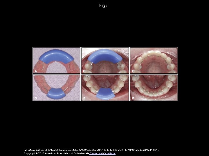 Fig 5 American Journal of Orthodontics and Dentofacial Orthopedics 2017 151812 -815 DOI: (10.