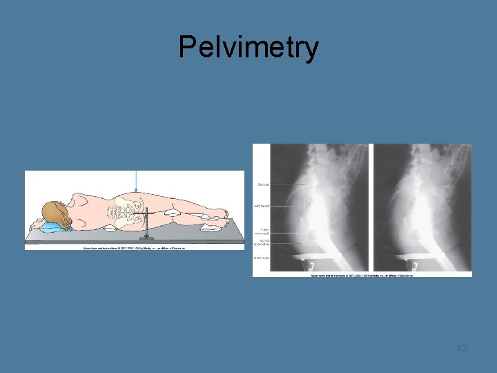 Pelvimetry 13 
