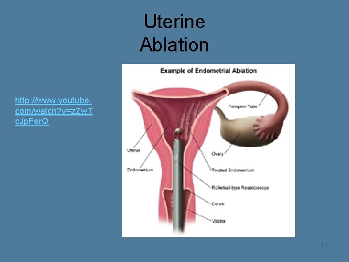 Uterine Ablation http: //www. youtube. com/watch? v=z. Zw. T c. Jp. Fer. Q 16