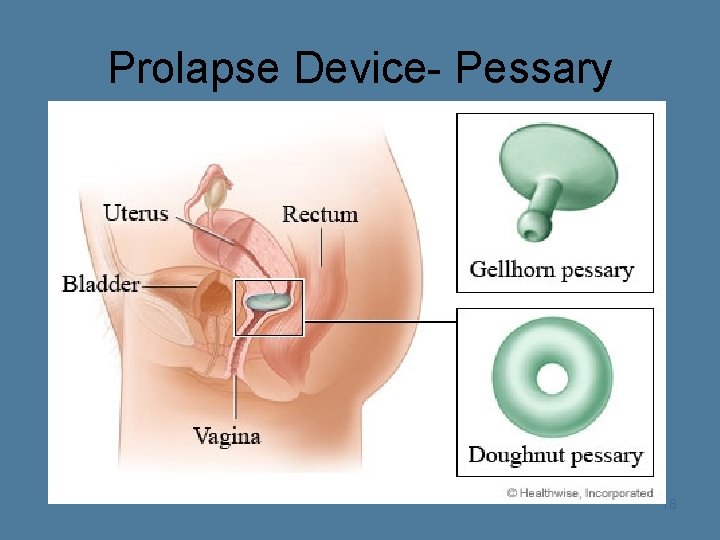Prolapse Device- Pessary 18 