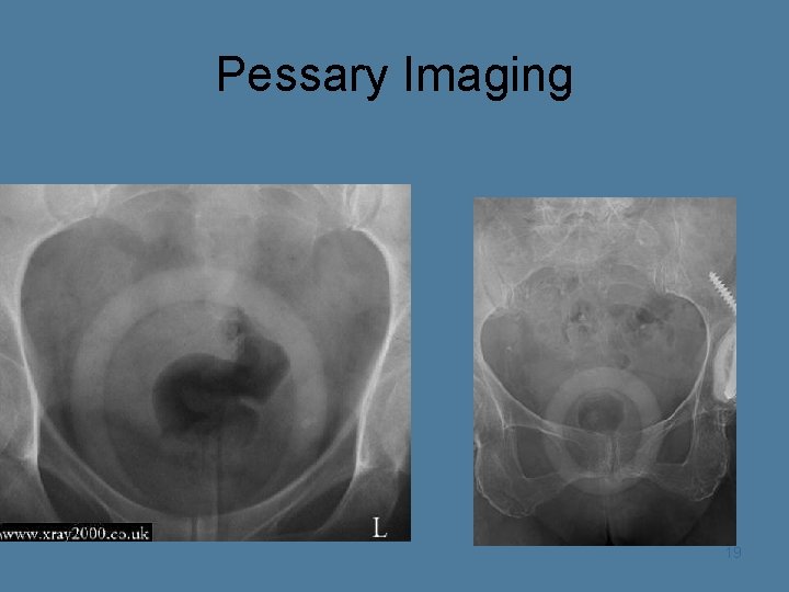 Pessary Imaging 19 