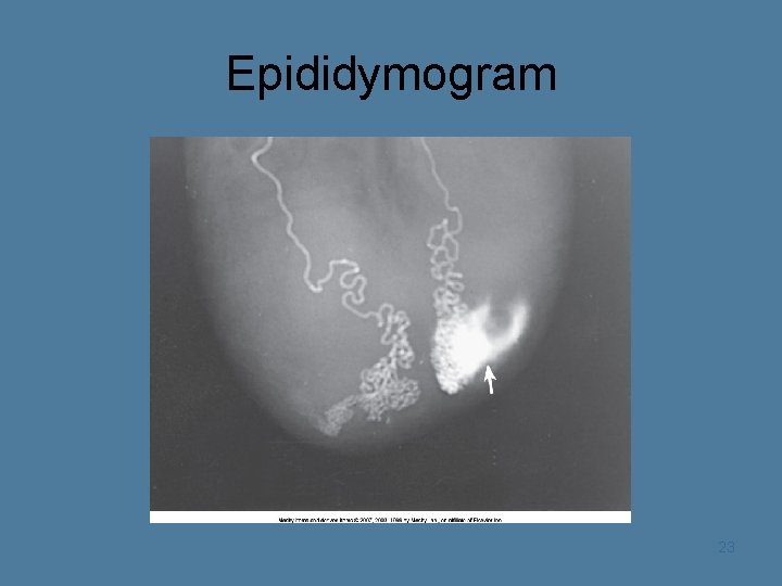 Epididymogram 23 