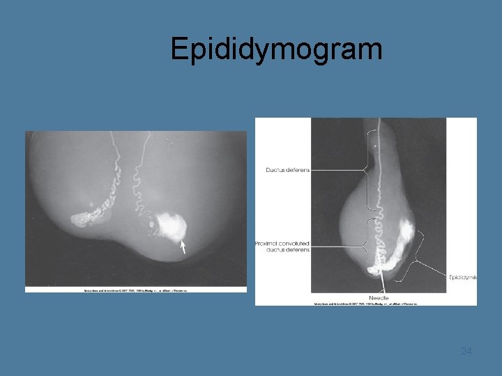 Epididymogram 24 
