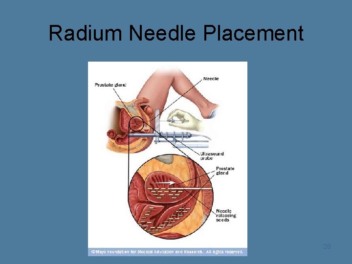 Radium Needle Placement 28 