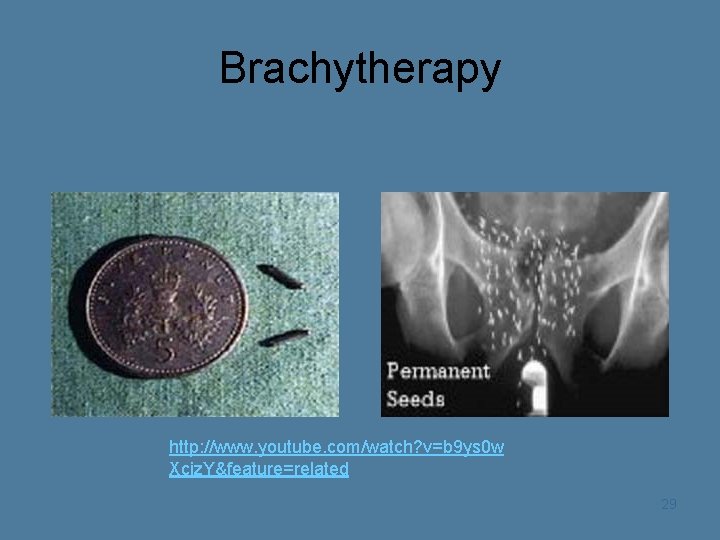 Brachytherapy http: //www. youtube. com/watch? v=b 9 ys 0 w Xciz. Y&feature=related 29 