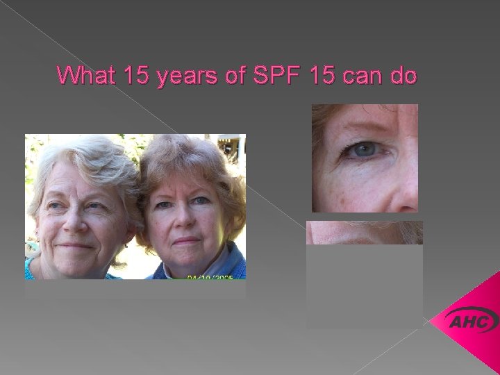 What 15 years of SPF 15 can do 