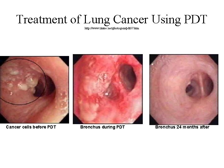 Treatment of Lung Cancer Using PDT http: //www. timtec. net/photogem/pdt 07. htm Cancer cells