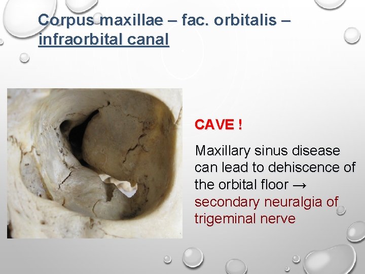 Corpus maxillae – fac. orbitalis – infraorbital canal CAVE ! Maxillary sinus disease can