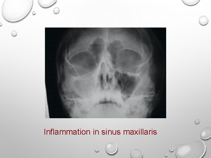 Inflammation in sinus maxillaris 