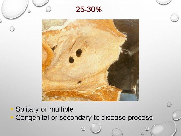 25 -30% § Solitary or multiple § Congenital or secondary to disease process 