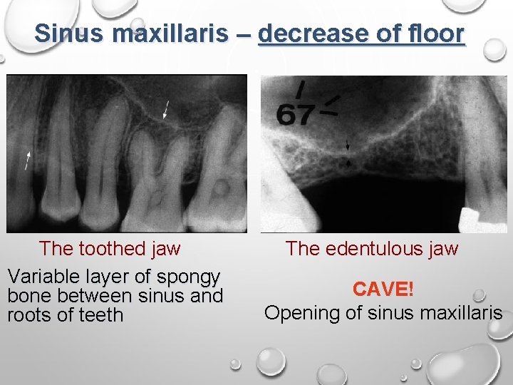 Sinus maxillaris – decrease of floor The toothed jaw Variable layer of spongy bone