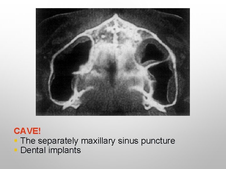 CAVE! § The separately maxillary sinus puncture § Dental implants 