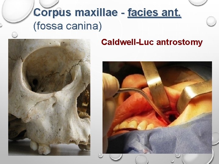 Corpus maxillae - facies ant. (fossa canina) Caldwell-Luc antrostomy 